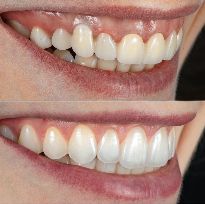 Veneers, Vor und Nach Ergebnis 