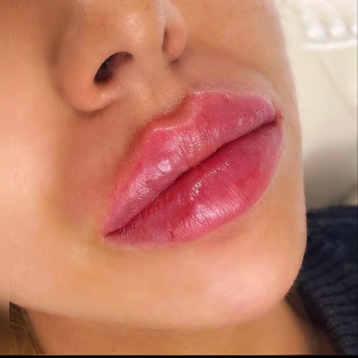 RUSSIAN LIPS - NAC-CLINIC - DR. AXEL NEUROTH 