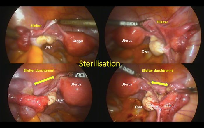 Gebärmutter, Eileiter und Eierstöcke vor und nach der Sterilisation - Eileiterdurchtrennung - in Berlin Frauenärzte am Potsdamer Platz Berlin-Mitte