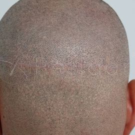 Haartransplantation auf Narbengewebe