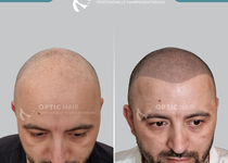 Bild zu Haarpigmentierung Köln | OpticHair