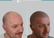 Bild zu Haarpigmentierung Köln | OpticHair
