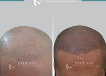 Bild zu Haarpigmentierung Berlin | OpticHair