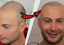 Bild zu Haarpigmentierung / Modern Hair Loss Solution