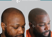 Bild zu Haarpigmentierung Berlin | OpticHair