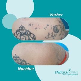 ENDLICH OHNE Tattooentfernung / Permanent Make-up Entfernung